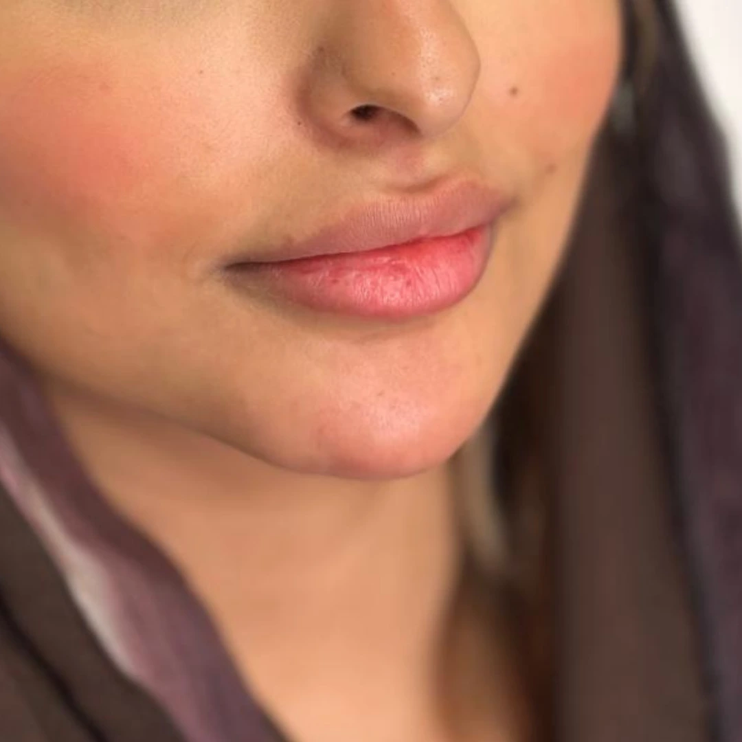 حالة فيلر شفايف في لوسيرا قبل 1