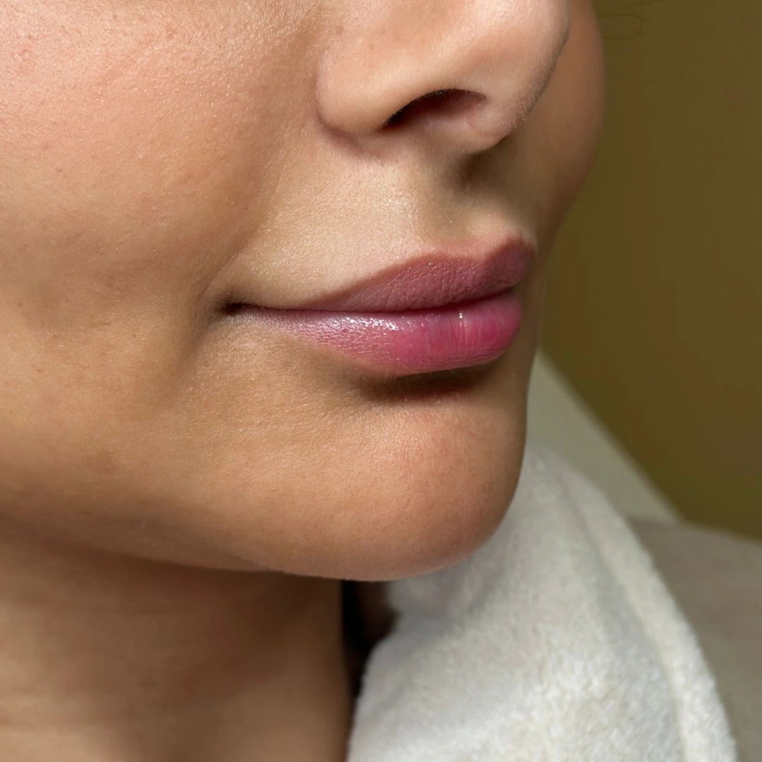 حالة 4 فيلر شفايف في عيادة لوسيرا قبل