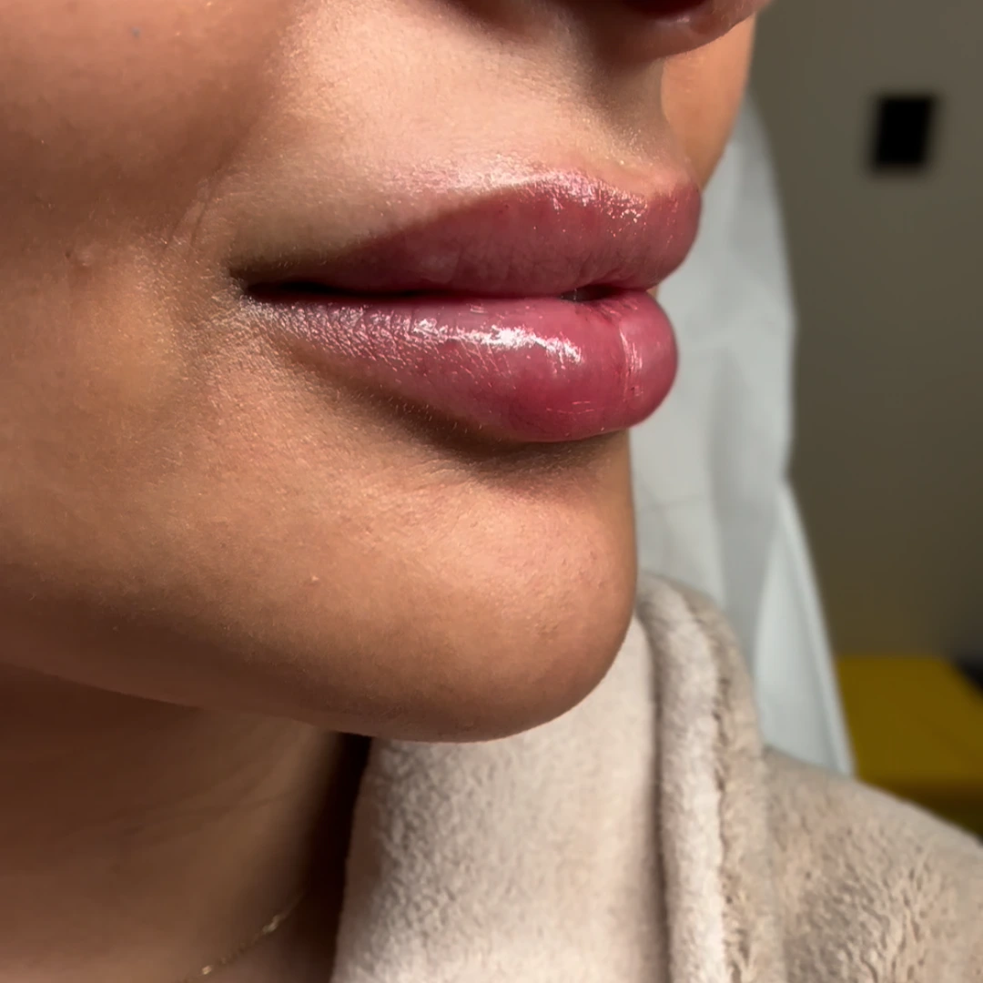 حالة 4 فيلر شفايف في عيادة لوسيرا بعد