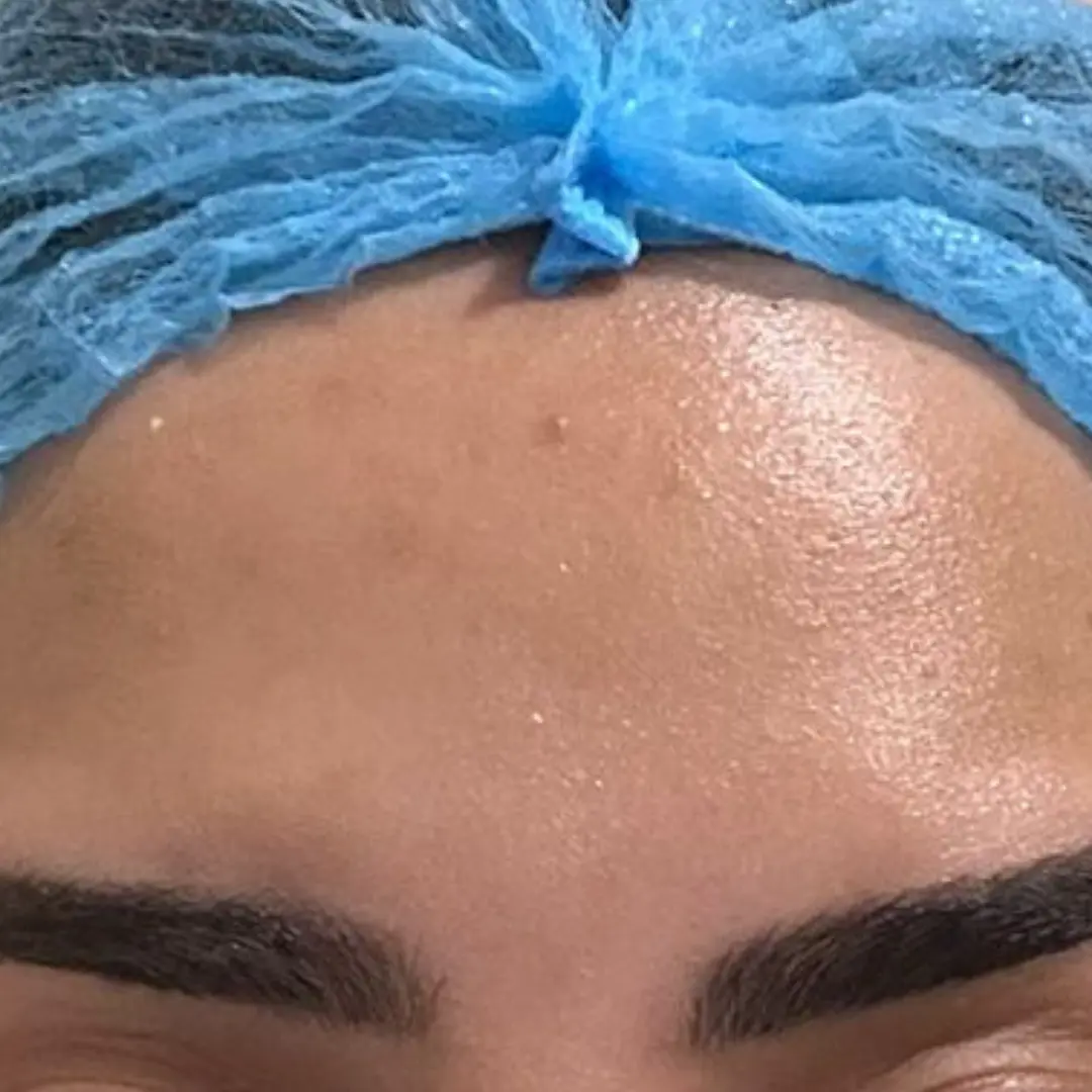 حالة 1 بوتكس في لوسيرا بعد