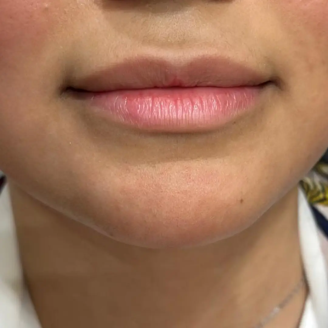 حالة فيلر شفايف في لوسيرا قبل 5