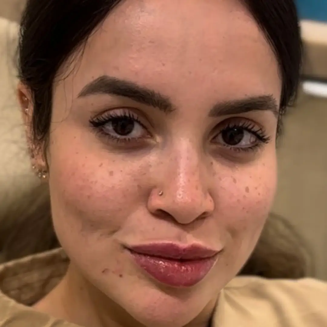 حالة فيلر شفايف في لوسيرا قبل 7