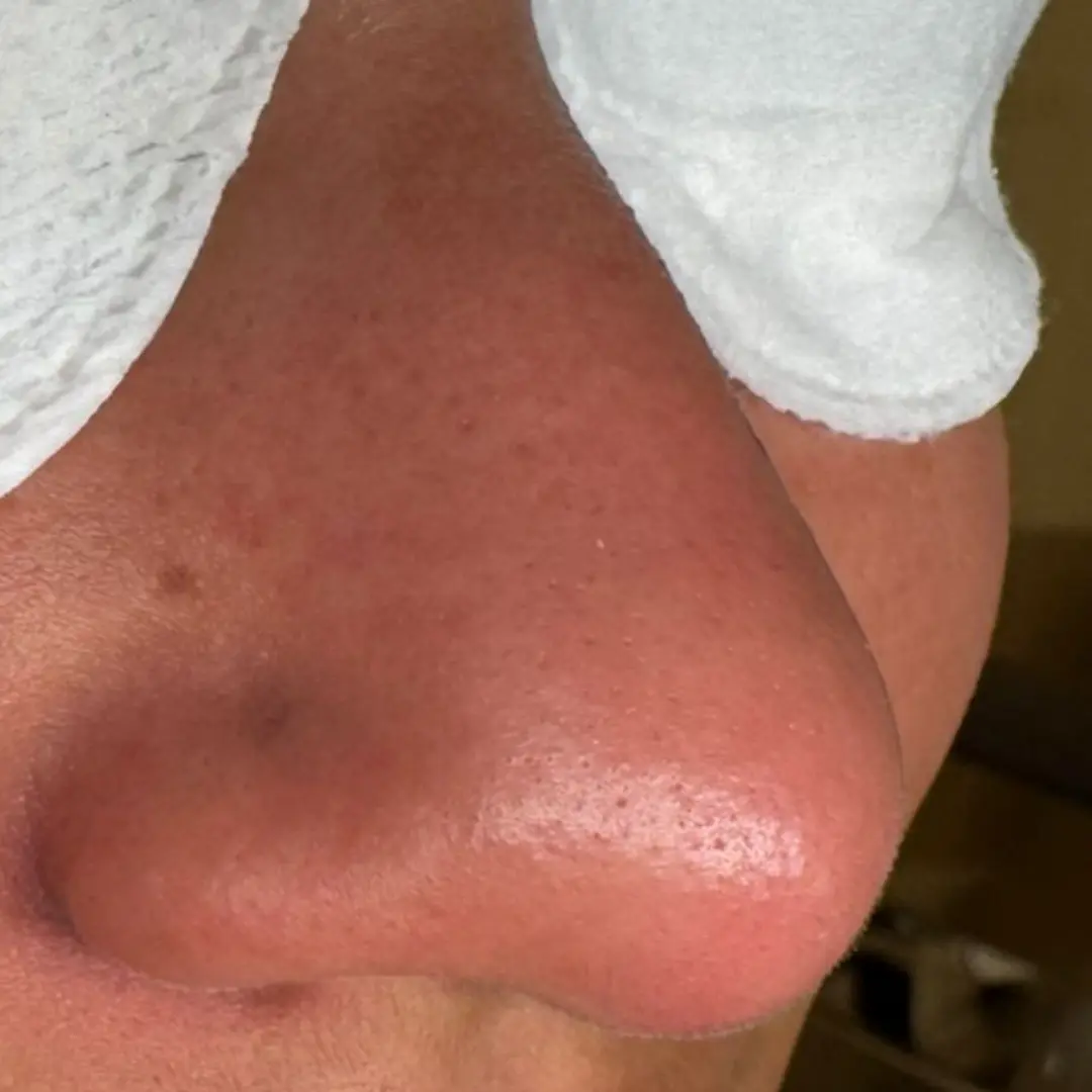 هايدرافيشيل في لوسيرا 2 بعد