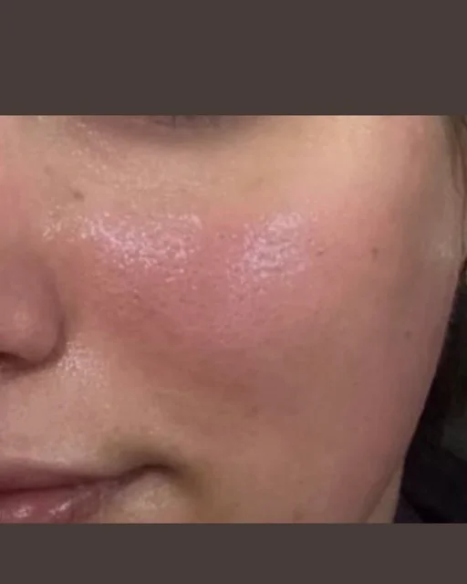 جلسات ميكرونيدلينغ