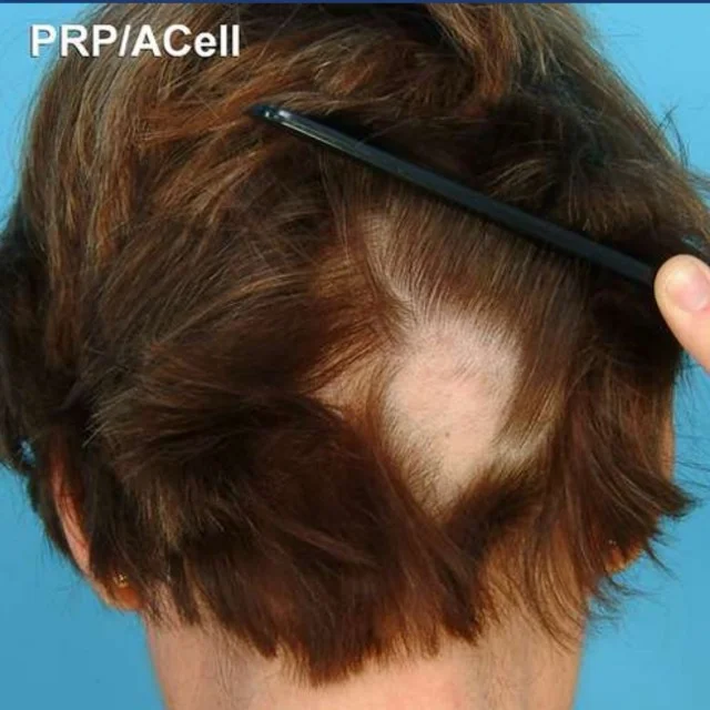 ابر بلازما للشعر