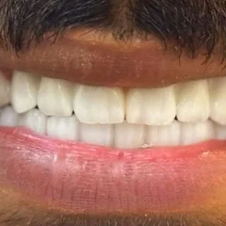 ابتسامات هوليود