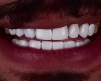 تبييض الاسنان في العيادات