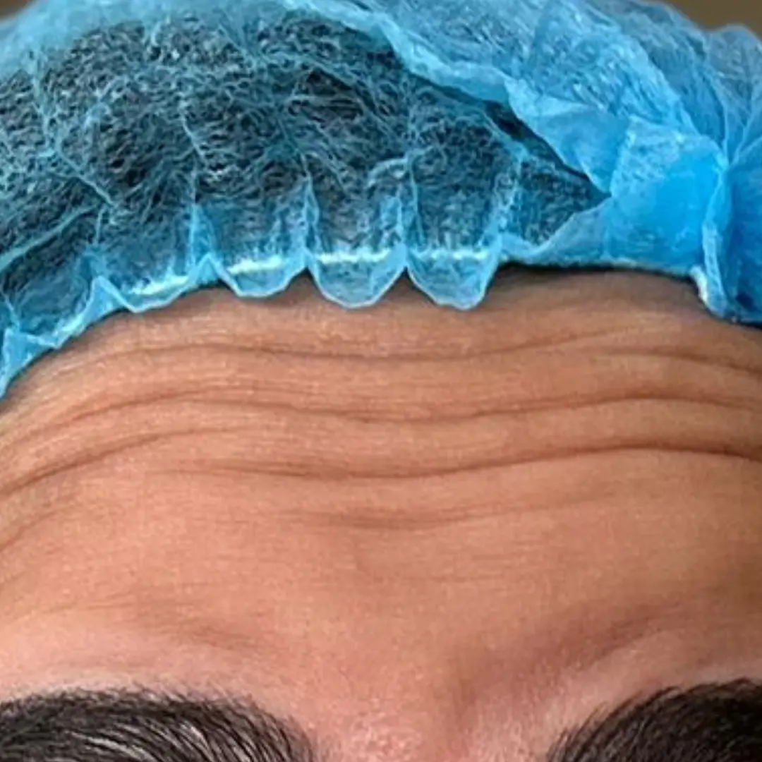 حالة-1-بوتكس-في-لوسيرا-قبل