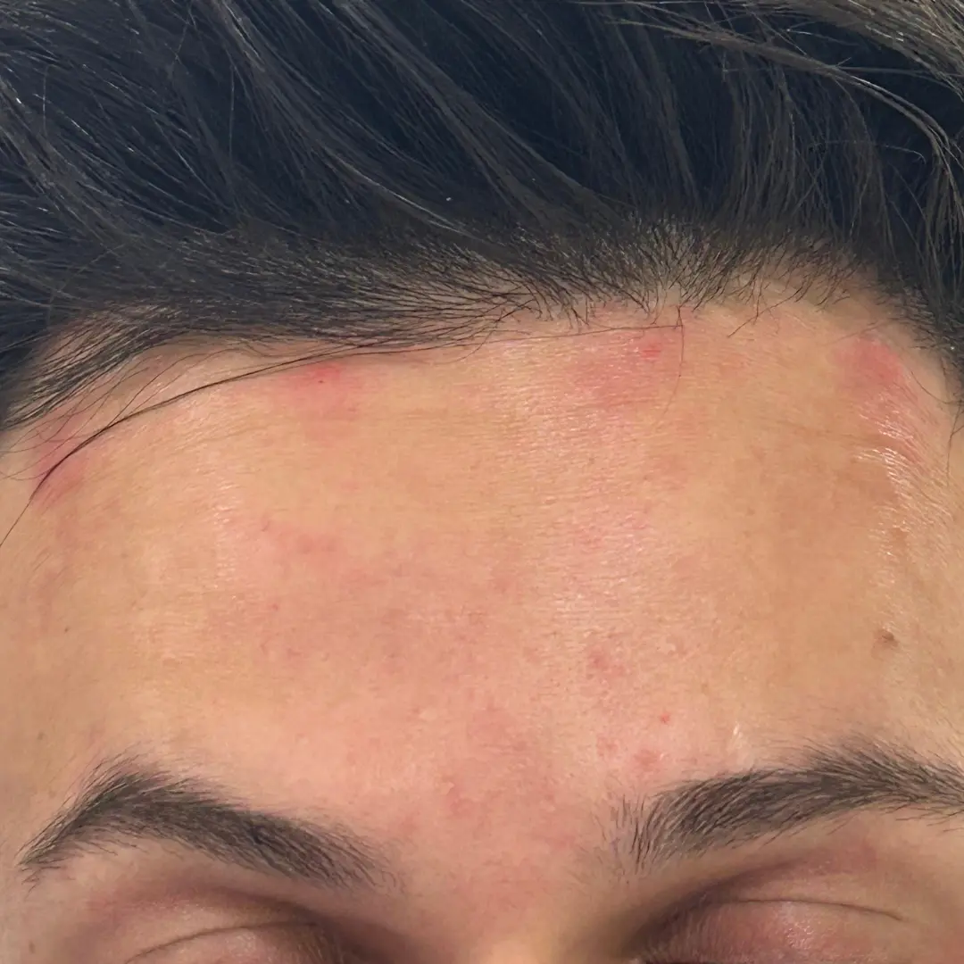 حالة-3-بوتكس-في-لوسيرا-بعد