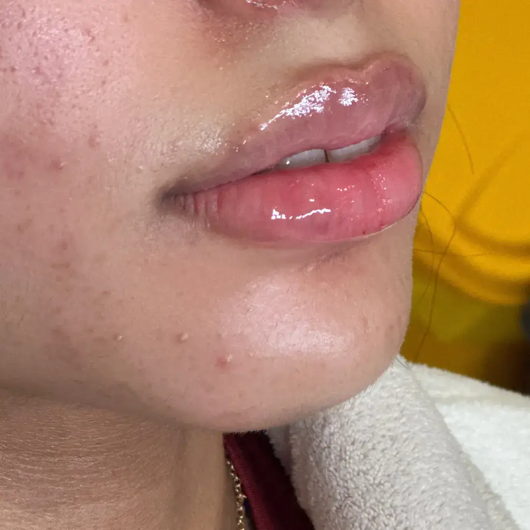 حالة-فيلر-شفايف-في-لوسيرا-بعد-6