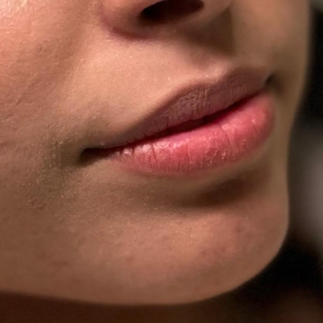 حالة-فيلر-شفايف-في-لوسيرا-قبل-6